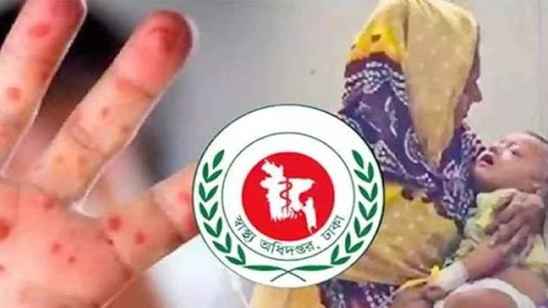 হামের উপসর্গে আরও ৪ জনের মৃত্যু