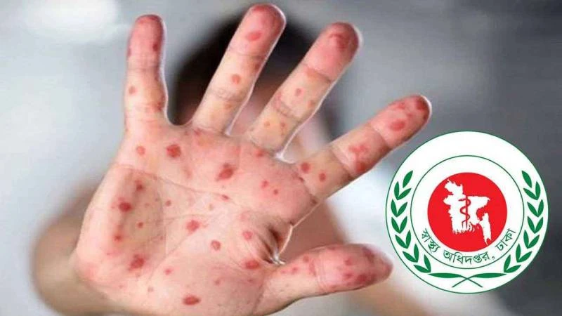 হাম উপসর্গে আরও ৩ শিশুর মৃত্যু