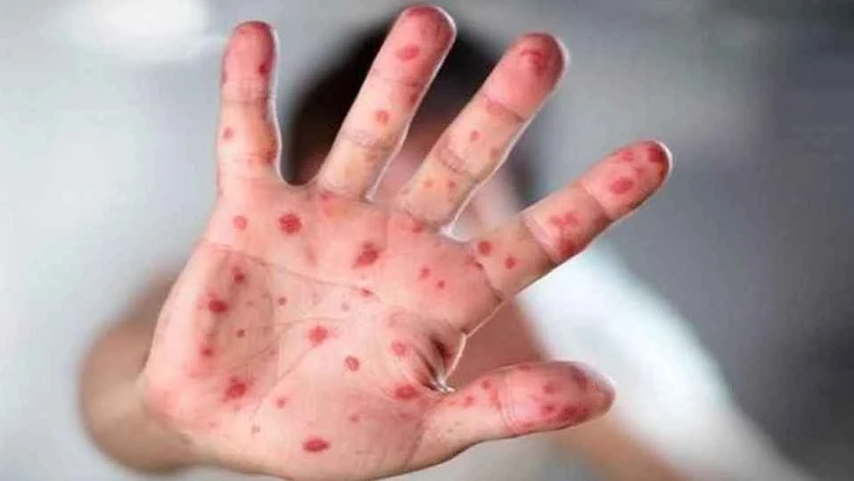 হাম ও উপসর্গে আরও ৫ শিশুর মৃত্যু