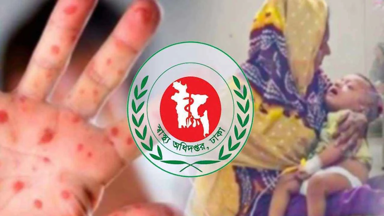 হাম উপসর্গে আরও ৪ শিশুর মৃত্যু