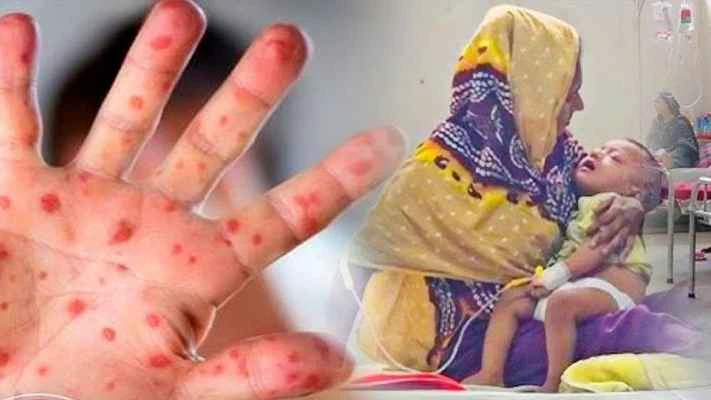 হাম উপসর্গে প্রাণ গেল আরও ৬ জনের