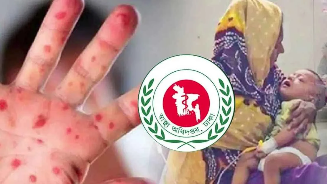 হাম উপসর্গে আরও ৭ শিশুর প্রাণহানি