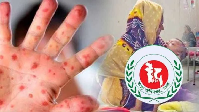 হাম উপসর্গে ১১ শিশুর মৃত্যু, চলতি মাসে একদিনে সর্বোচ্চ