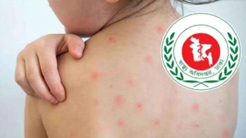 হাম উপসর্গে আরও ৪ জনের মৃত্যু