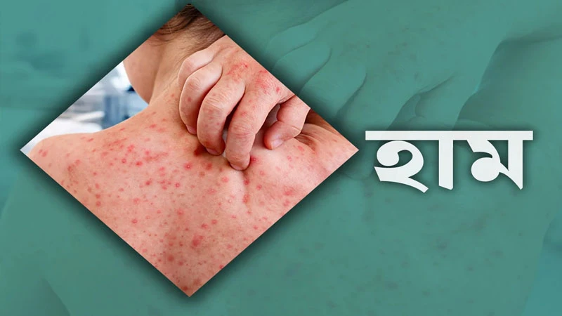 ২৪ ঘণ্টায় হাম উপসর্গে আরও ৬ জনের মৃত্যু