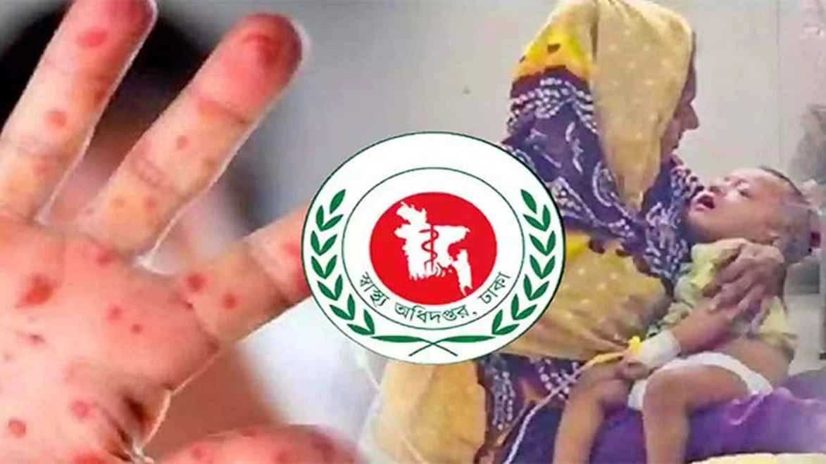 হাম ও উপসর্গে আরও ৭ শিশুর মৃত্যু