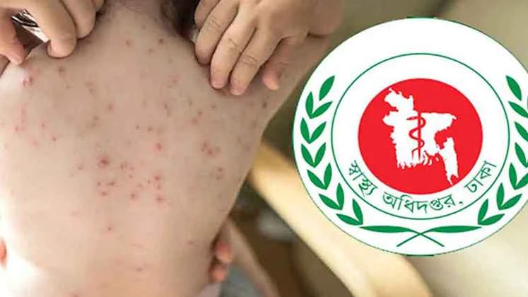 হাম উপসর্গে প্রাণ গেল আরও ৬ শিশুর