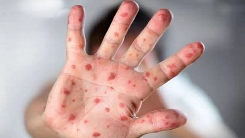 হামের উপসর্গে আরও ৫ শিশুর প্রাণহানি