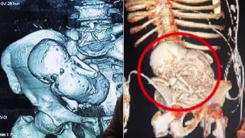 প্রসবের ভয়ে হাসপাতাল থেকে পালিয়েছিলেন, ৩৬ বছর পর পেট থেকে মিলল ‘পাথর শিশু’