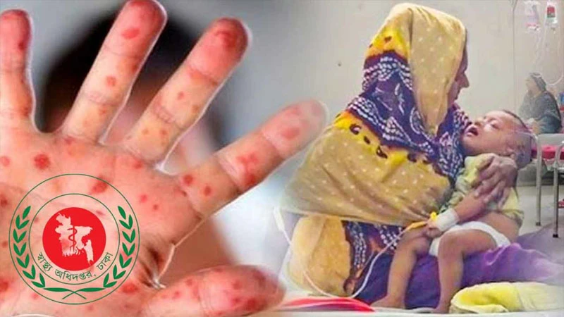 হাম উপসর্গে আরও ৮ জনের মৃত্যৃ