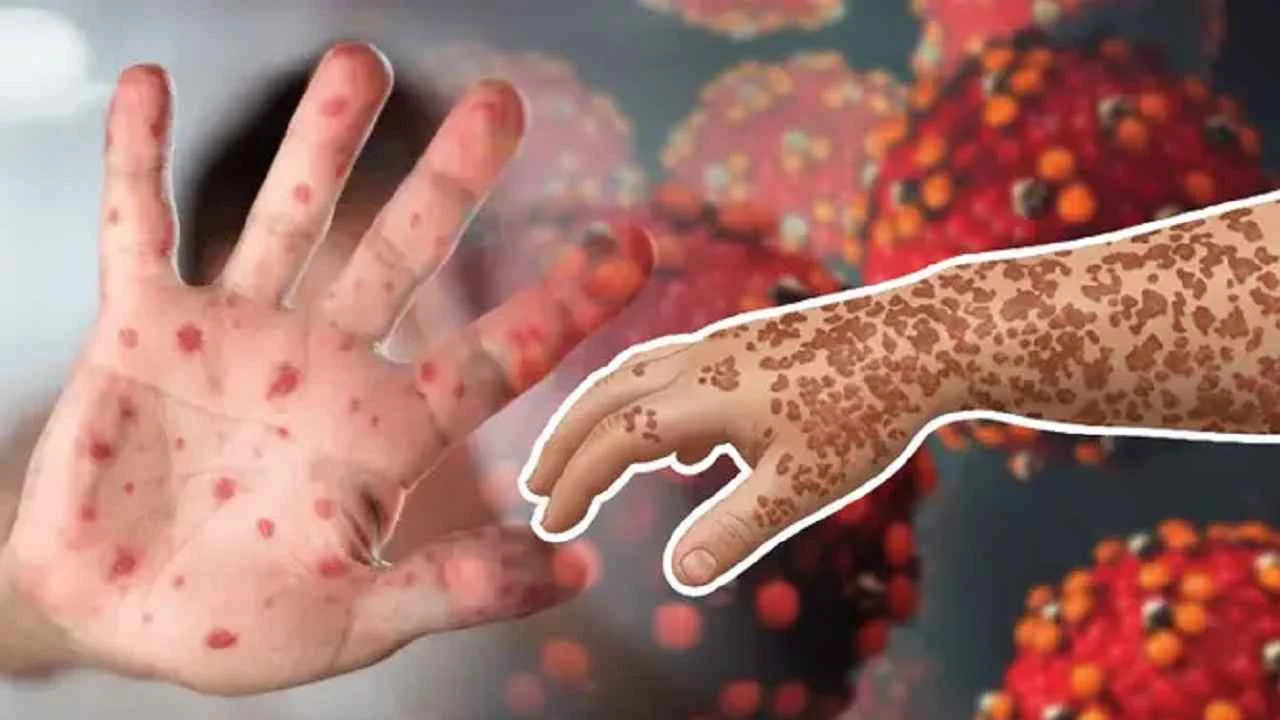 হাম ও উপসর্গে আরও ১১ জনের মৃত্যু