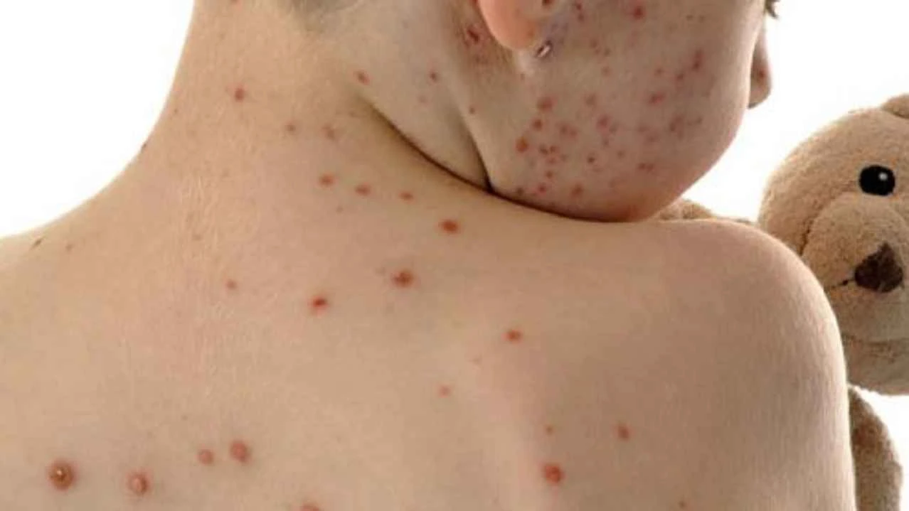 হামের উপসর্গে আরও ১০ জনের মৃত্যু, আক্রান্ত ১১ হাজার ছাড়িয়েছে