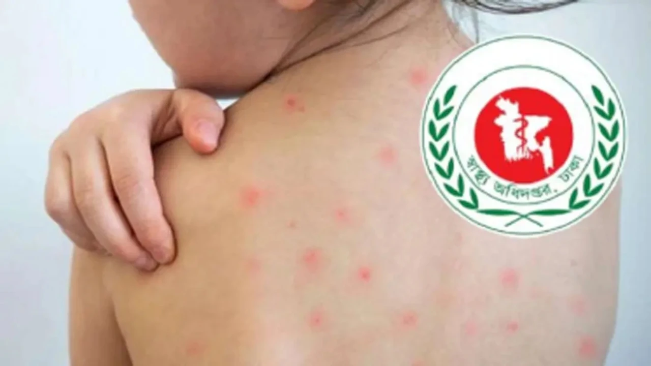 হাম উপসর্গে আরও ৫ শিশুর মৃত্যু