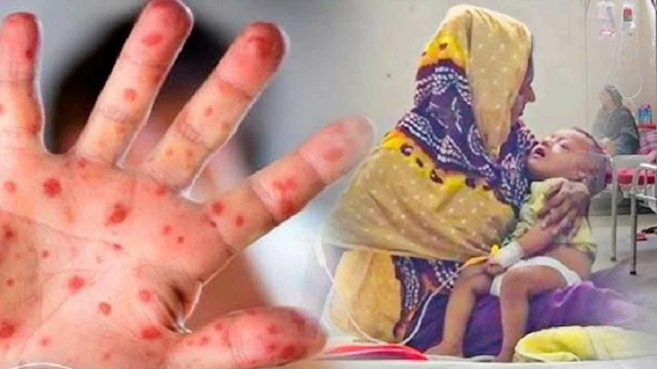 হাম ও উপসর্গে আরও ৭ শিশুর মৃত্যু