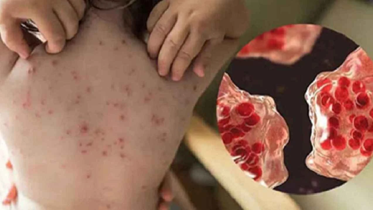হাম ও উপসর্গে আরও ৯ শিশুর প্রাণহানি