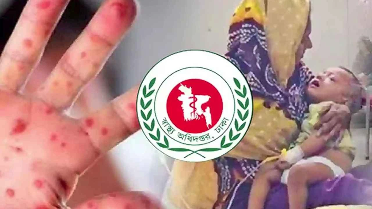 হাম ও উপসর্গে মৃত্যু ৫০০ ছাড়াল