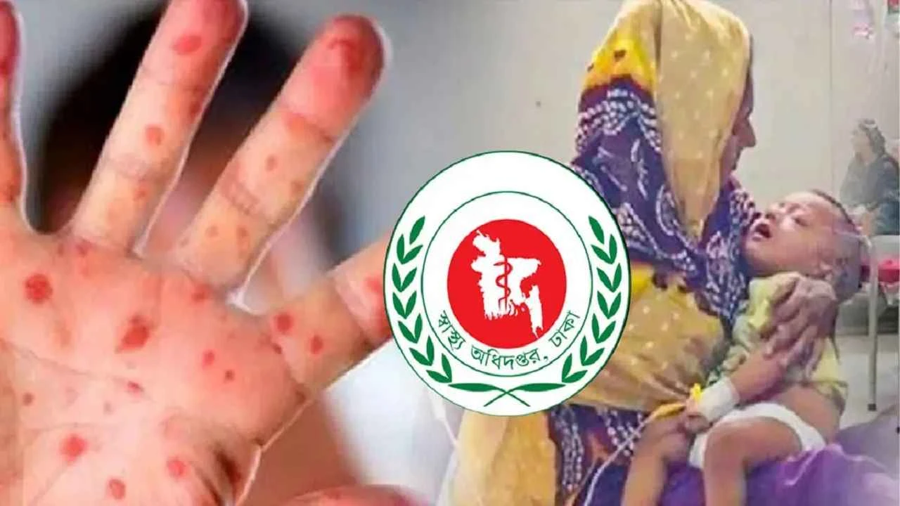 হাম-উপসর্গে প্রাণ গেল আরও ১৬ শিশুর