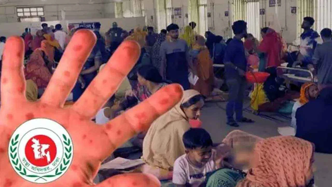 হাম উপসর্গে আরও ৫ শিশুর মৃত্যু
