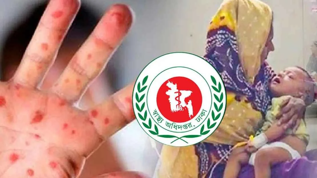 হাম উপসর্গে আরও ৪ শিশুর মৃত্যু, নতুন রোগী ১১৭৪